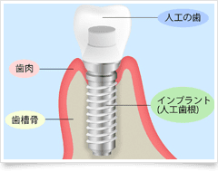 インプラントの図解